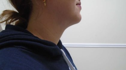 Chin Before & After Patient #473