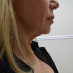 Chin Before & After Patient #476
