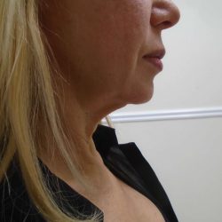 Chin Before & After Patient #476