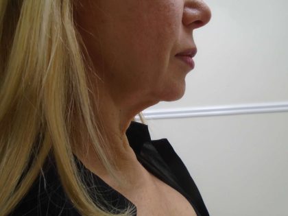 Chin Before & After Patient #476