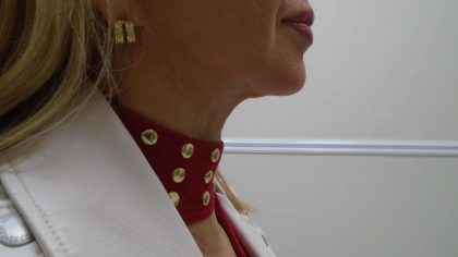 Chin Before & After Patient #476