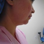 Chin Before & After Patient #441