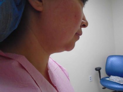 Chin Before & After Patient #441