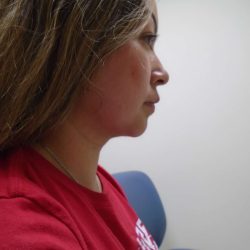 Chin Before & After Patient #441