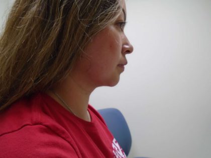 Chin Before & After Patient #441