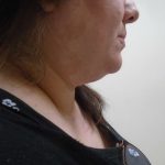 Chin Before & After Patient #444