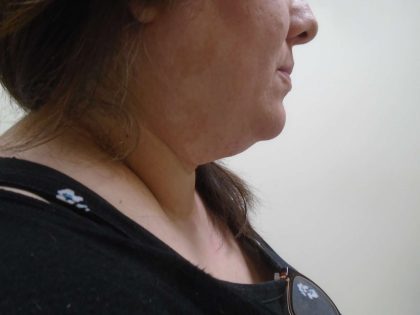 Chin Before & After Patient #444