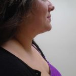 Chin Before & After Patient #444