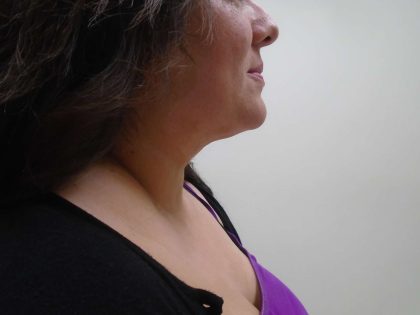 Chin Before & After Patient #444