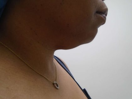 Chin Before & After Patient #447