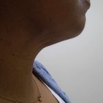 Chin Before & After Patient #447