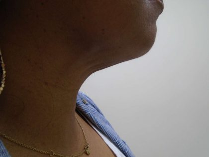 Chin Before & After Patient #447