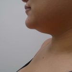 Chin Before & After Patient #450