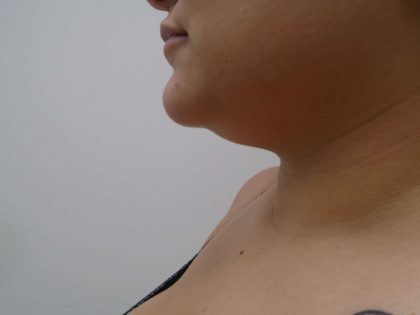 Chin Before & After Patient #450