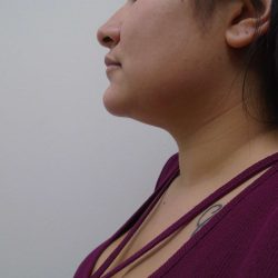 Chin Before & After Patient #450
