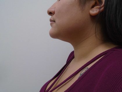 Chin Before & After Patient #450