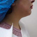 Chin Before & After Patient #455
