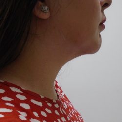 Chin Before & After Patient #455