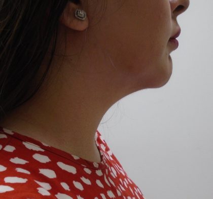 Chin Before & After Patient #455