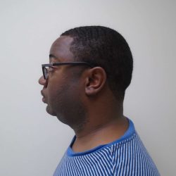 Chin Before & After Patient #458