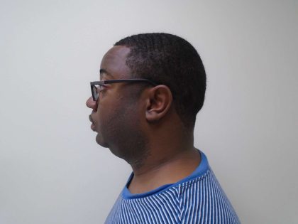 Chin Before & After Patient #458