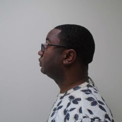 Chin Before & After Patient #458