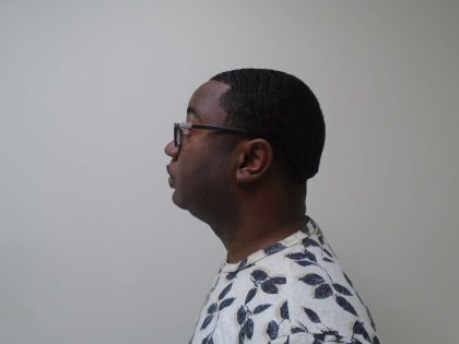 Chin Before & After Patient #458