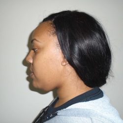 Chin Before & After Patient #461