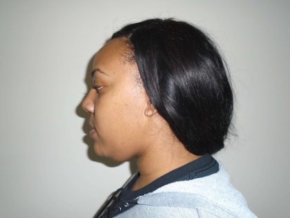 Chin Before & After Patient #461