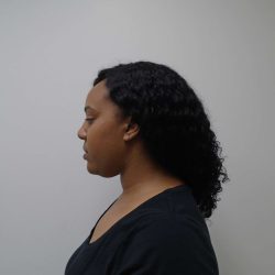Chin Before & After Patient #461