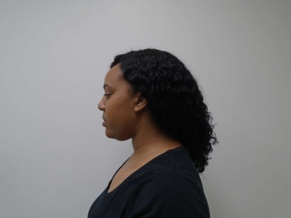 Chin Before & After Patient #461