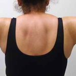 Arm Liposuction Before & After Patient #140