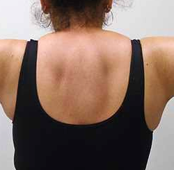 Arm Liposuction Before & After Patient #140
