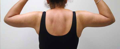 Arm Liposuction Before & After Patient #140