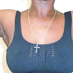 Arm Liposuction Before & After Patient #143