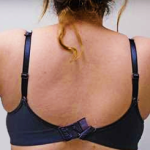 Arm Liposuction Before & After Patient #263