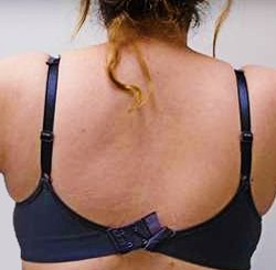 Arm Liposuction Before & After Patient #263