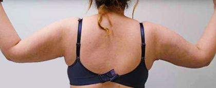 Arm Liposuction Before & After Patient #263