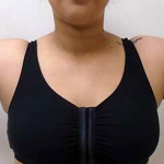 Arm Liposuction Before & After Patient #137
