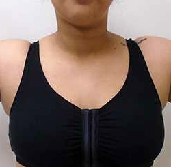 Arm Liposuction Before & After Patient #137