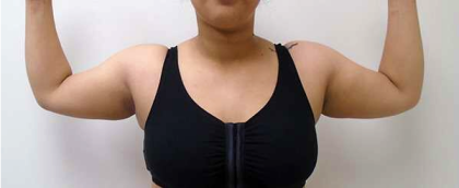Arm Liposuction Before & After Patient #137