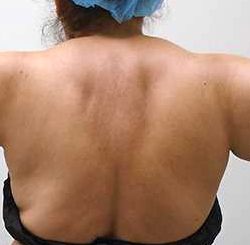 Arm Liposuction Before & After Patient #140
