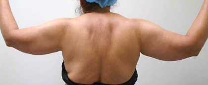 Arm Liposuction Before & After Patient #140