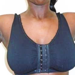 Arm Liposuction Before & After Patient #143