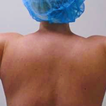 Arm Liposuction Before & After Patient #263