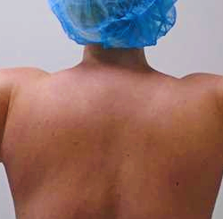 Arm Liposuction Before & After Patient #263