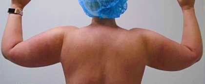Arm Liposuction Before & After Patient #263