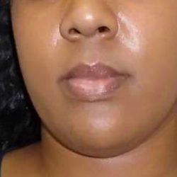 Chin Before & After Patient #296