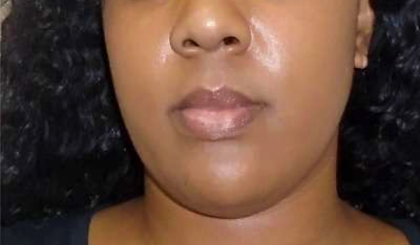 Chin Before & After Patient #296