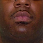 Chin Before & After Patient #299